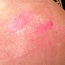 My blister butt marks :-( still showing after 5 weeks....