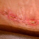 Eeww this is what a infection looks like. Sorry kinda graphic