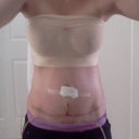 day3-  Swollen!  Skin is tight and shinny. The T incision looks bigger part of it is permanent marker from surgery.