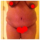 Yes, my right breast hangs lower