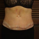 Day five post OP.