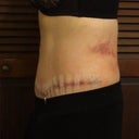 Day five post OP.