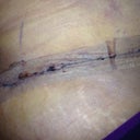 Incision looking pretty good 8 days PO