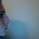 my profile before the surgery