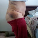 Still swollen and bruised day 3