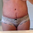 13 days PO. Getting ready to get my stitches out.
