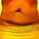 Yuck Pre op