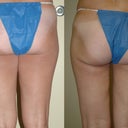Before and after lipo.  Back view