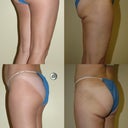 Before and after lipo, side view.  Lintner's excessive lipo left deep creases extending out to my thighs.  He said he didn't lipo enough and needed to "feather out" the areas.  He said the sagging was due to my age, not his lipo skills.