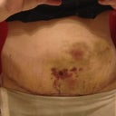 Wednesday 03/27/2013 9 days post op. Still very swollen with a large hard hematoma.