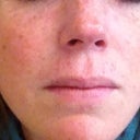 Before the procedure - Thurs afternoon, Feb 16th, 2012