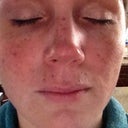 Right after - you can see the freckles darkening immediately.  Taken Feb 16th 2012
