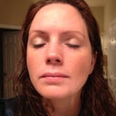 Taken 6 days after the procedure on Feb 22, 2012.  Not bad!  But I still want to get rid of some of the lighter freckles that will be tougher to uproot.  :)