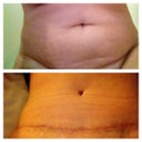Tummy before and after