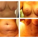 Boobs and tummy before and after