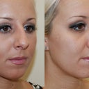 before and after (3 months post surgery)