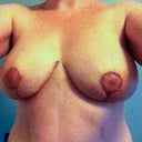 6 days post-op.