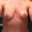 Before, uneven, large areolas, droopy!