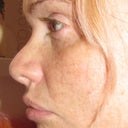 before nasal filler and lip enhancement 
