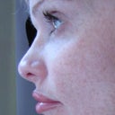 after nasal filler and lip enhancement