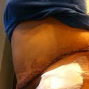 Rt side 7 days post surgery