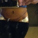 Front 7 days post surgery