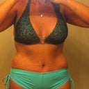 a little swelling over my hips,  wks po