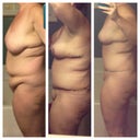 Before, right after, 6 weeks