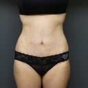 Mini Abdominoplasty With Liposuction