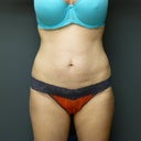 Mini Abdominoplasty With Liposuction