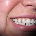 Pre-Invisalign - Img 1