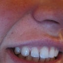 Pre-Invisalign - Img 2