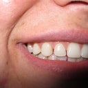 Pre-Invisalign - Img 3