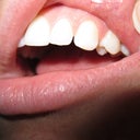 Pre-Invisalign - Img 4