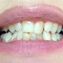 April 2012 before Invisalign.