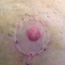 Left boob: second of 2 small scabs left)