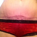 My scar.