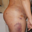 five days post op side view