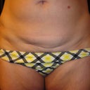 so you can see the c-section scar and skin shelf