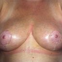 Post Op Day 26