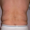 47 Year Old Man Has Liposuction Surgery