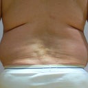 47 Year Old Man Has Liposuction Surgery