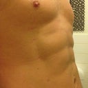 A month after surgery - you can clearly see the small scars here, which I'm hoping will fade completely. I'm thinking of having Laser treatment on them to help them heal and fade.