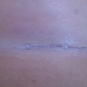 Scar day 28 PO