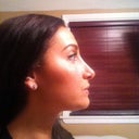 side view 9 weeks post op