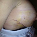 Left breast, feeling virtually no pain:)