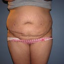 Front view before surgery. The small incisions are from my robotic hysterectomy only 3 weeks before my tt.