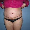 Post op tt 1 week, front view.