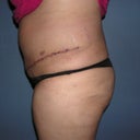 Post op tt 1 week, side view.