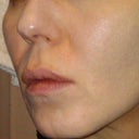 After Restylane injections